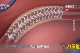 国内首款可降解的冠脉支架！降解后会产生二氧化碳和水视频封面