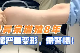 10岁男孩骨异常增殖8年，右腿严重变形，这些症状要警惕！视频封面