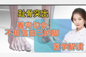 医学解读 人体脚趾骨突出怎么办 看医生如何进行切割矫正