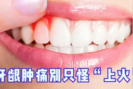 牙龈肿痛不一定就是上火，引起牙龈肿痛的3大原因，早知道早防范视频封面