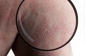 大腿内侧：起红疙瘩很痒怎么回事？遇到这种情况并非全是过敏造成视频封面