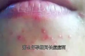 怀孕期间特别容易长痘，尤其是下巴长得厉害，原来是这么回事！视频封面