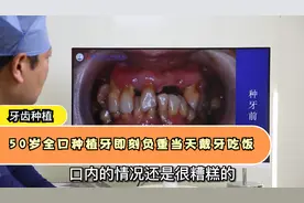 50岁一口牙松动咬不了东西，全部拔掉做全口即刻种植当天戴牙吃饭视频封面