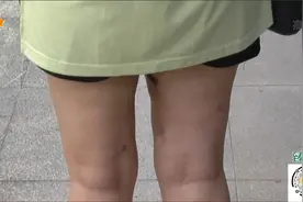 花2万8做抽脂手术  大腿凹凸不平视频封面