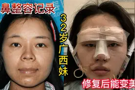 32岁广西妹隆鼻记录，肋骨鼻第二次修复，15天成功逆袭变女神视频封面