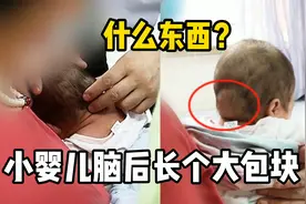 小婴儿脑后长了个大包块，这是什么东西？视频封面
