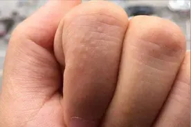 手上起小水泡是怎么回事？很多人都有，还不知道的赶紧看看