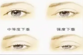 如何拯救“死鱼眼”？眼睛无神可能是因为“上睑下垂”视频封面