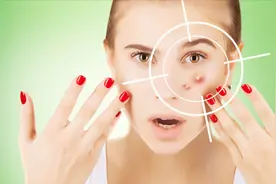 祛痘专家 | 使用阿达帕林凝胶治闭口粉刺，会先爆痘吗