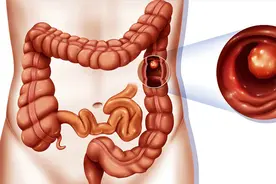 肠道肿瘤标志物有哪些？