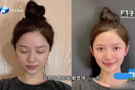 “精灵耳”走红整容圈，“招风耳”成香饽饽，做“网红脸”需谨慎视频封面