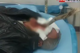 男子遭木棍插面穿喉 医生紧急“面中取木”视频封面