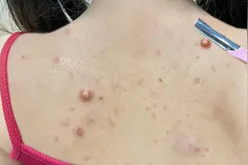 后背长痘别再挤了！低成本居家祛痘法来袭！满背痘痘洗洗就断根！视频封面