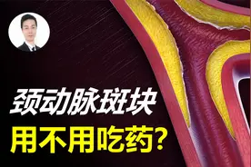 发现“颈动脉斑块”就得吃降脂药吗？满足三个条件，可以先不吃！视频封面