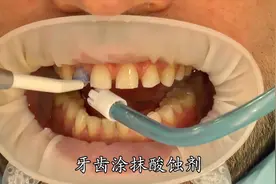 牙齿的牙缝大？有缺了一半？没关系！！补上就行了视频封面