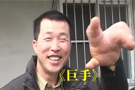 男人天生巨手，一只手是成人的三倍，医生也无能力为，《巨手》视频封面