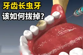 被虫牙支配有多痛苦？一分钟演示换牙过程，看完忍不住挤牙槽视频封面