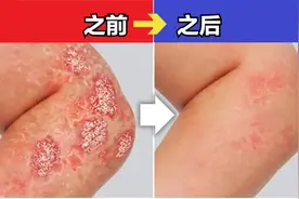 解析牛皮癣缓解新思路，你一定没想到，它溃疡性结肠炎有关联视频封面