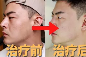 点阵激光（治疗前～治疗后）10天全记录视频封面