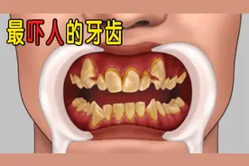 超级解压！长时间嗑瓜子，男子牙齿东倒西歪，医生：必须拔掉！视频封面