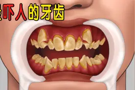 超级解压！长时间嗑瓜子，男子牙齿东倒西歪，医生：必须拔掉！视频封面