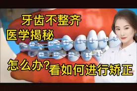 医学演绎 人体牙齿不整齐 龅牙 地包天 如何进行修复 牙套使用视频封面