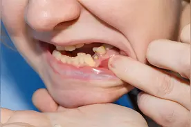 女人梦见自己掉牙齿是什么征兆，意味着什么？视频封面