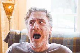 老人的舌头感染成了坏疽！