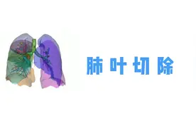 肺叶切除3D模拟
