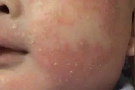 刚出生15天的宝宝满脸红疹，全家带娃看病，奶奶的经验被医生怒斥视频封面