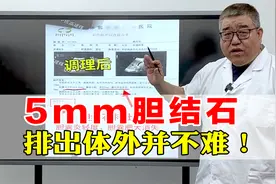 5毫米胆结石，用这个方法，已经排出体外！ 不用非得做手术！