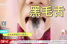 舌头发黑是什么情况？专家给出三种情况，快看看你有这种症状吗？视频封面