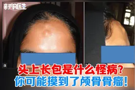 头上长包是什么怪病？你可能摸到了颅骨骨瘤！