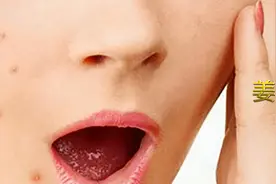 姜汤洗脸改善痤疮