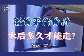患者受伤导致胫骨平台骨折，手术18个月后行走困难是什么原因？视频封面