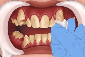 第一视角还原带牙套全过程，畸形牙齿如何矫正？