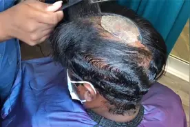 女子头顶头发都掉光了，带上假发遮住后，一下年轻十岁视频封面