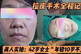 真人实拍：拉皮手术全程记录，42岁女士“年轻10岁不止”视频封面
