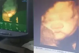 宝妈临产前做彩超，爸爸看到四维照连连感叹：这大脸瓜子视频封面