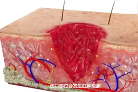 人类皮肤划破之后，伤口到底如何愈合的？网友直呼不敢信视频封面