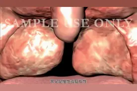 医生说的扁桃体切除术过程是什么样的？Tonsillectomy 医学视频