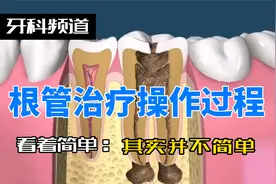 根管治疗的操作过程，看着简单，做好却不简单视频封面