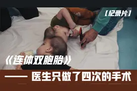 纪录片：罕见头部连体双胞胎，经历四次手术，最终成功被分离视频封面