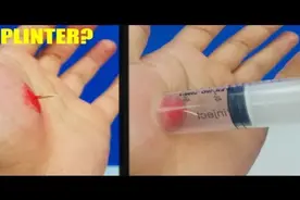 木刺深深的扎进肉里取不出来咋办？别急，看看牛人是这样解决的！视频封面