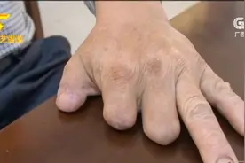 河池大化：工伤断了三个手指 该赔偿多少算够？视频封面