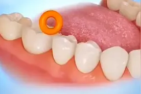 长沙看牙 | 牙齿间隙小怎么办？视频封面