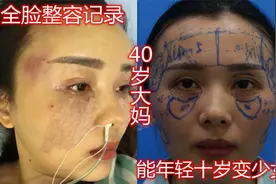 40岁大妈整容全脸实录，30天后换脸实拍！朋友说年轻十岁变少女视频封面