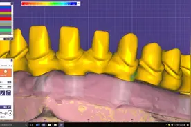 快来跟牙宝一起学习如何用EXOCAD软件设计马龙桥