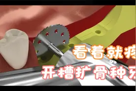 劈骨植入种植牙全过程，看着生疼！开槽扩骨太可怕了视频封面