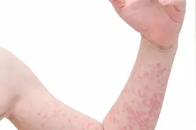 冷风一吹就起疹子，竟然是荨麻疹？谈谈寒冷性荨麻疹